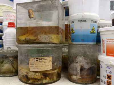 Ci sono polmoni che sembrano grosse spugne, cervelli tagliati a met�, un cuore con aorta colpito da aneurisma, stomaci con ulcere e fegati cirrotici